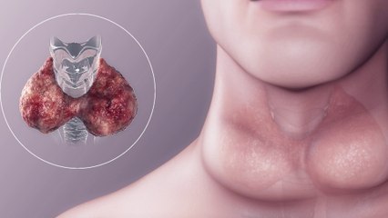 bd-historia-familiar-influye-en-casos-de-tiroides-090223