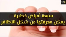 أهم سبعة أمراض خطيرة يمكن معرفتها من شكل الأظافر