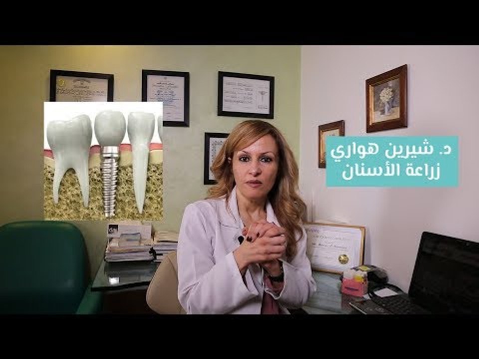 كيفية زراعة الأسنان