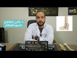 أنواع كسور العظام وكيفية علاجها