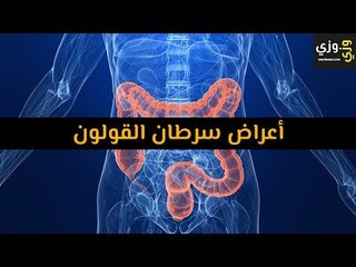 أهم أعراض سرطان القولون