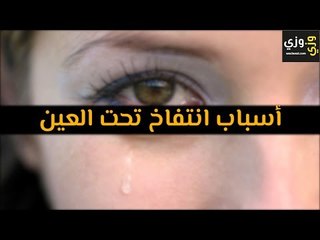 أهم أسباب انتفاخ تحت العين