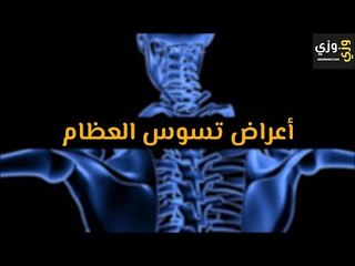أهم أعراض تسوس العظام