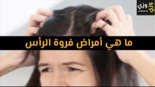 أهم أمراض فروة الرأس