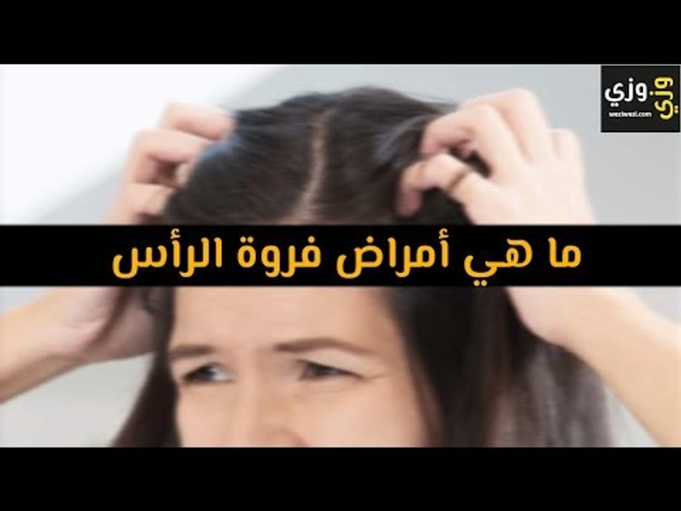 أهم أمراض فروة الرأس