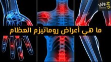 أهم ما هي أعراض روماتيزم العظام