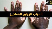 أهم أسباب البهاق المفاجئ