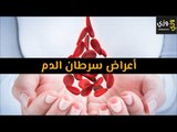 أهم أعراض سرطان الدم
