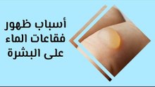 أهم أسباب ظهور فقاعات الماء على البشرة
