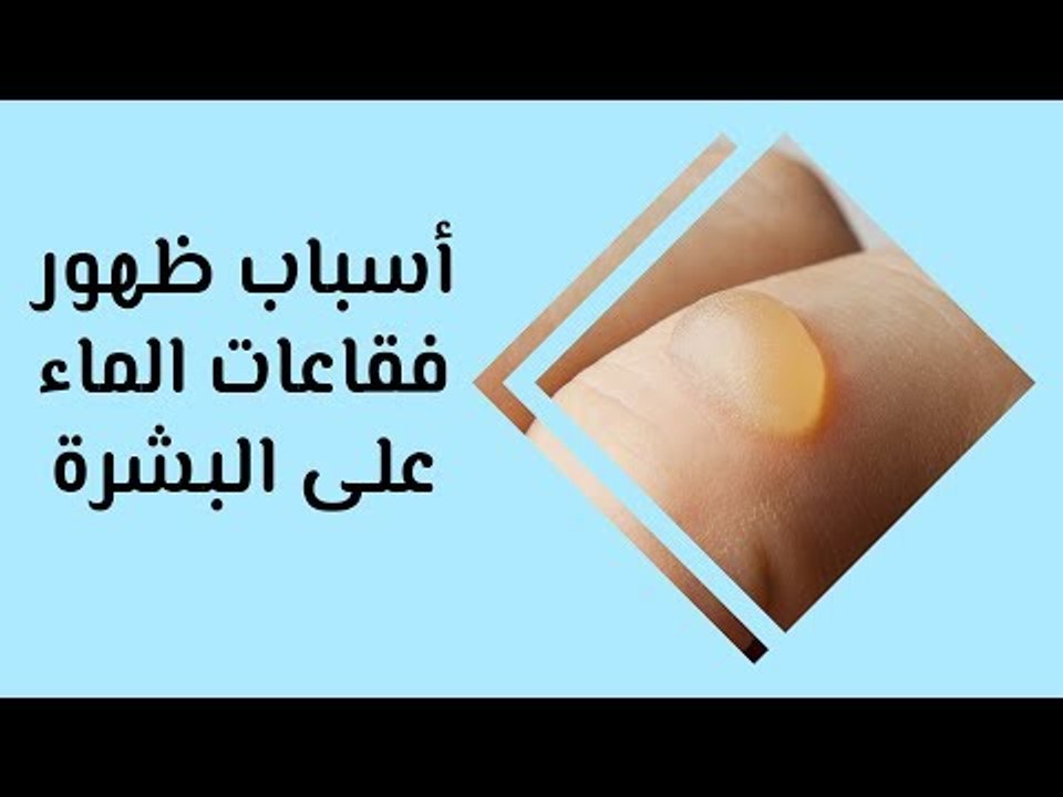 أهم أسباب ظهور فقاعات الماء على البشرة