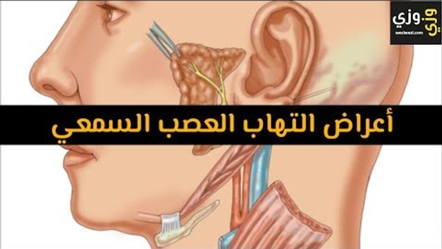 أهم أعراض التهاب العصب السمعي