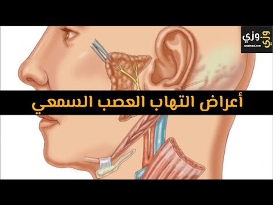 أهم أعراض التهاب العصب السمعي