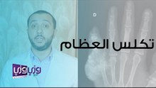 ما هو تكلس العظم وما هي أسبابه وعلاجه