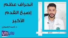 انحراف عظم إصبع القدم الكبير