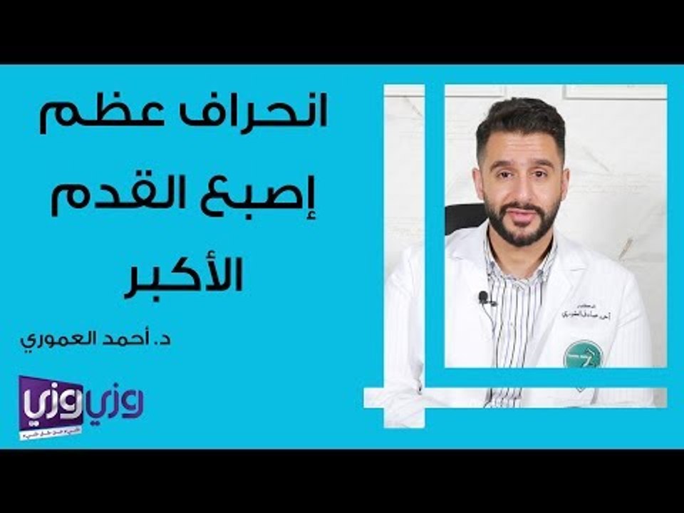 انحراف عظم إصبع القدم الكبير