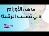 ما هي الأورام التي تصيب الرقبة