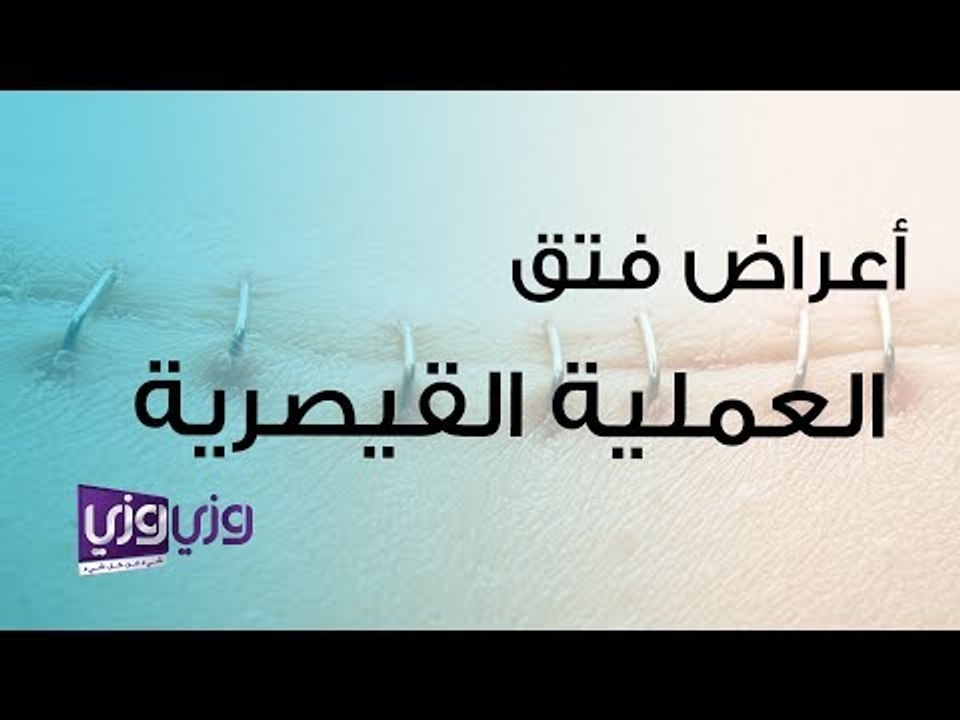 أعراض فتق العملية القيصرية