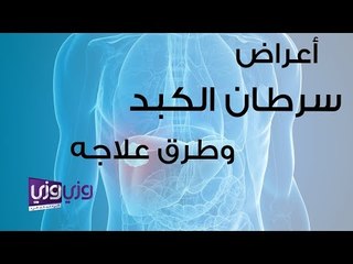 اعراض سرطان الكبد وطرق علاجه