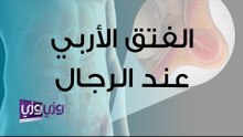 الفتق الأربي عند الرجال