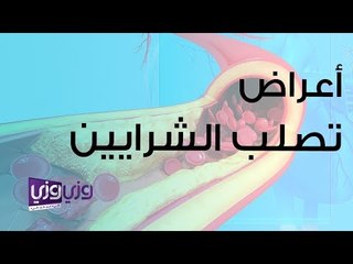 أعراض تصلب الشرايين