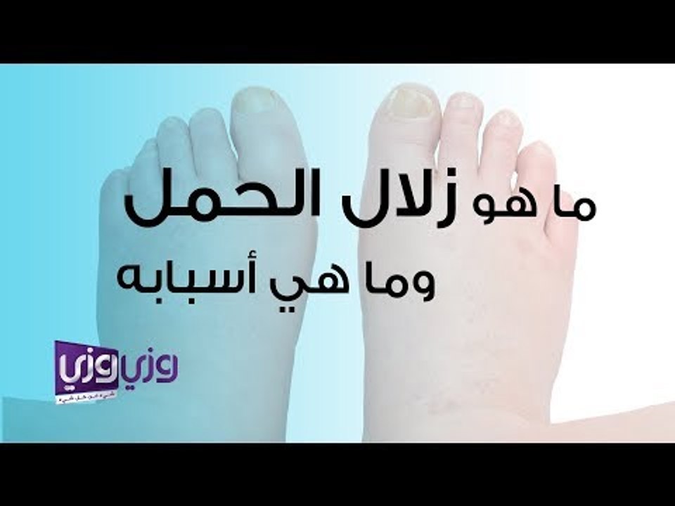 ما هو زلال الحمل وما هي الأسباب التي تؤدي إلى الإصابة به