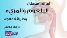 أعراض سرطان البلعوم والمريء وعلاجه