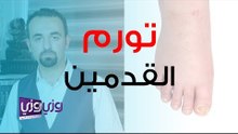 علاج تورم القدمين