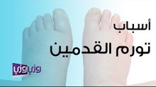 أسباب تورم القدمين