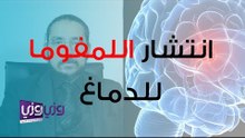 انتشار أورام الجهاز اللمفاوي في الدماغ