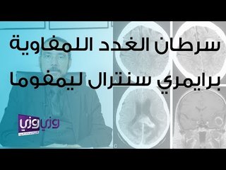 سرطان الغدد اللمفاوية برايمري سنترال ليمفوما