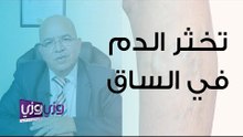 أسباب تخثر الدم في الساق والعلاجات المقترحة
