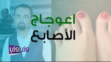 أسباب اعوجاج أصابع القدم وطرق علاجه