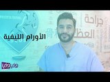 الأورام العضلية الليفية