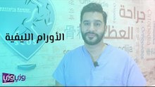 الأورام العضلية الليفية