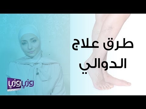 الخيارات المتاحة في علاج الدوالي