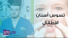 تسوس أسنان الأطفال