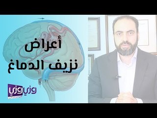 أعراض نزيف الدماغ وعلاجه