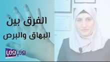 الفرق بين البهاق والبرص