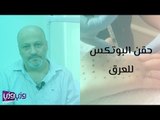 حقن البوتکس للعرق