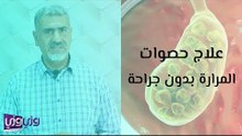 علاج حصوات المرارة بدون جراحة