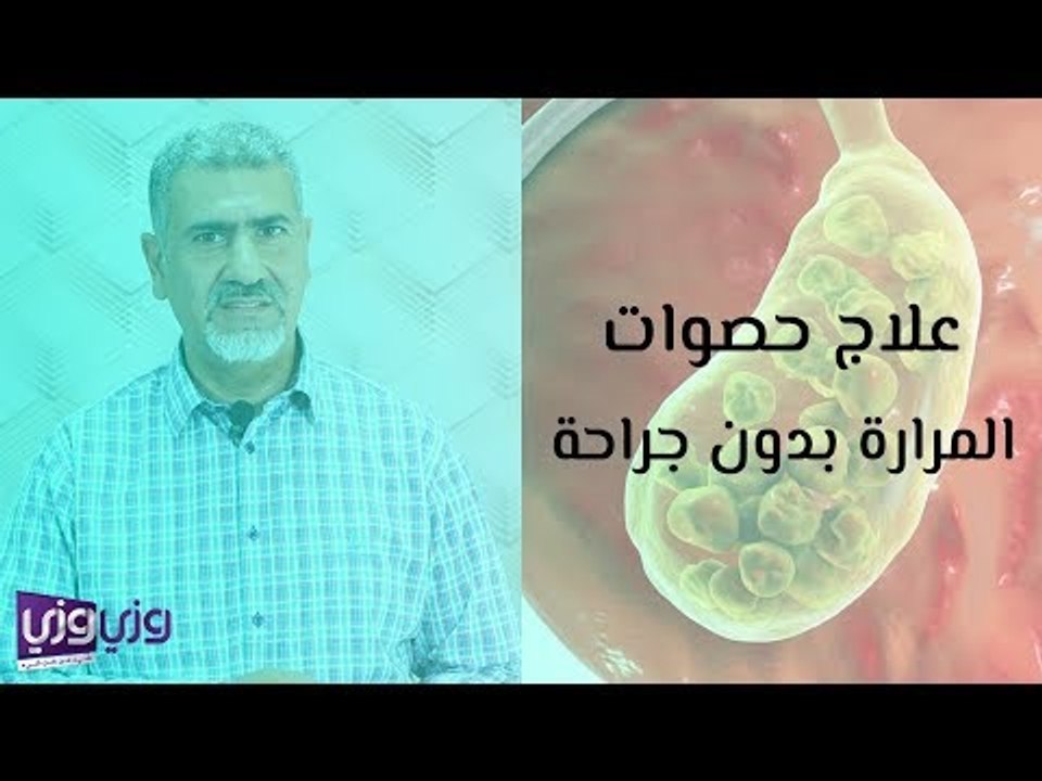علاج حصوات المرارة بدون جراحة