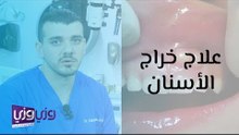 علاج خراج الأسنان