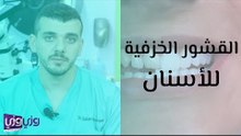 القشور الخزفية للأسنان
