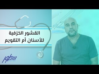 القشور الخزفية للأسنان أم التقويم