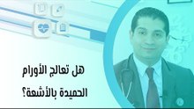 هل تعالج الأورام الحميدة بالأشعة؟