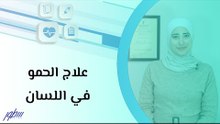 علاج الحمو في اللسان