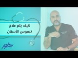 كيف يتم علاج تسوس الأسنان