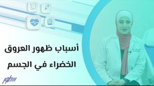 أسباب ظهور العروق الخضراء في الجسم
