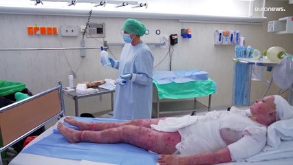 شاهد: أطباء نرويجيون يزرعون جلدا لفتاة تعرضت لحروق على 85٪ من جسمها وكُتب لها عمر جديد