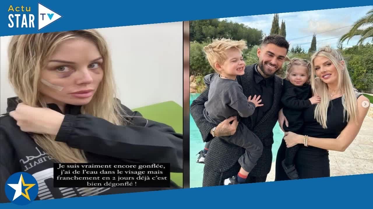 "J'ai enlevé mes pansements" : Jessica Thivenin dévoile son visage après sa nouvelle opération